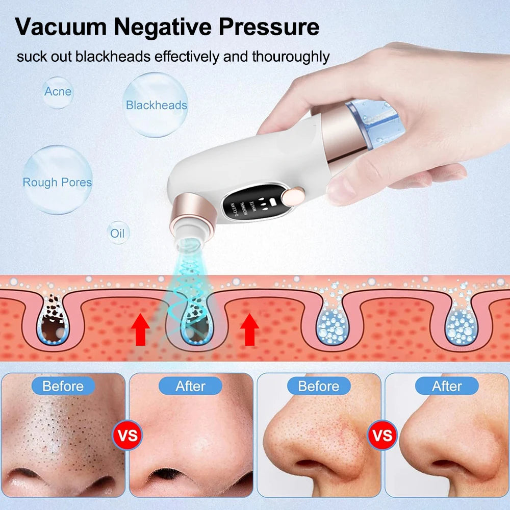 Electric Blackhead Remover & Pore Vacuum Cleaner