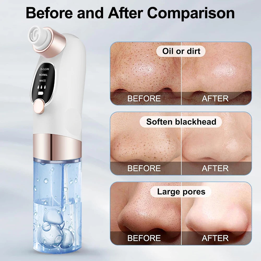 Electric Blackhead Remover & Pore Vacuum Cleaner